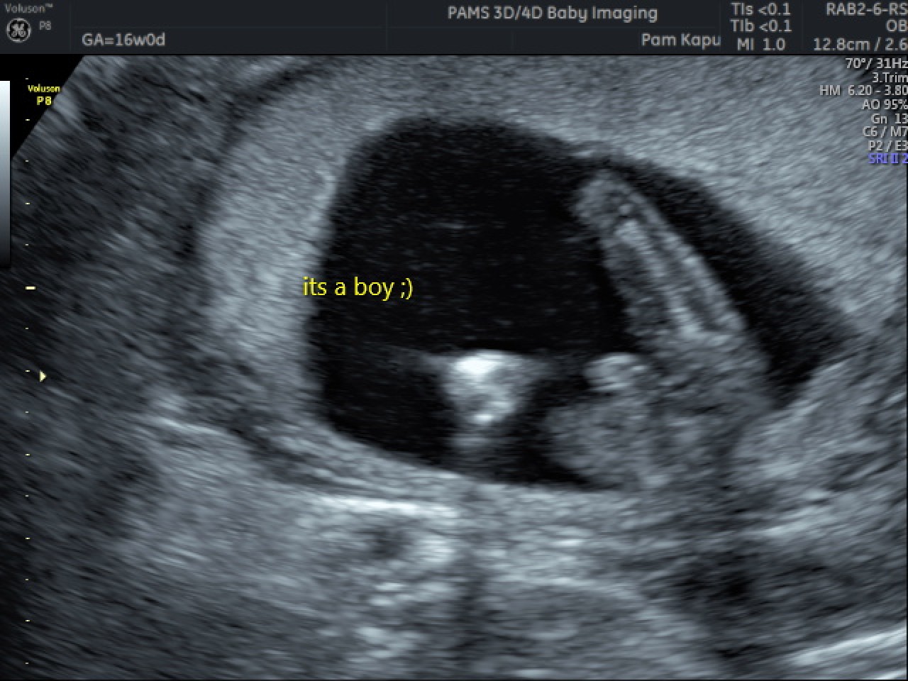 Gender Reveal Scan Private One On One Pregnancy And Fertility Ultrasound Scans Norwich Pams 5670