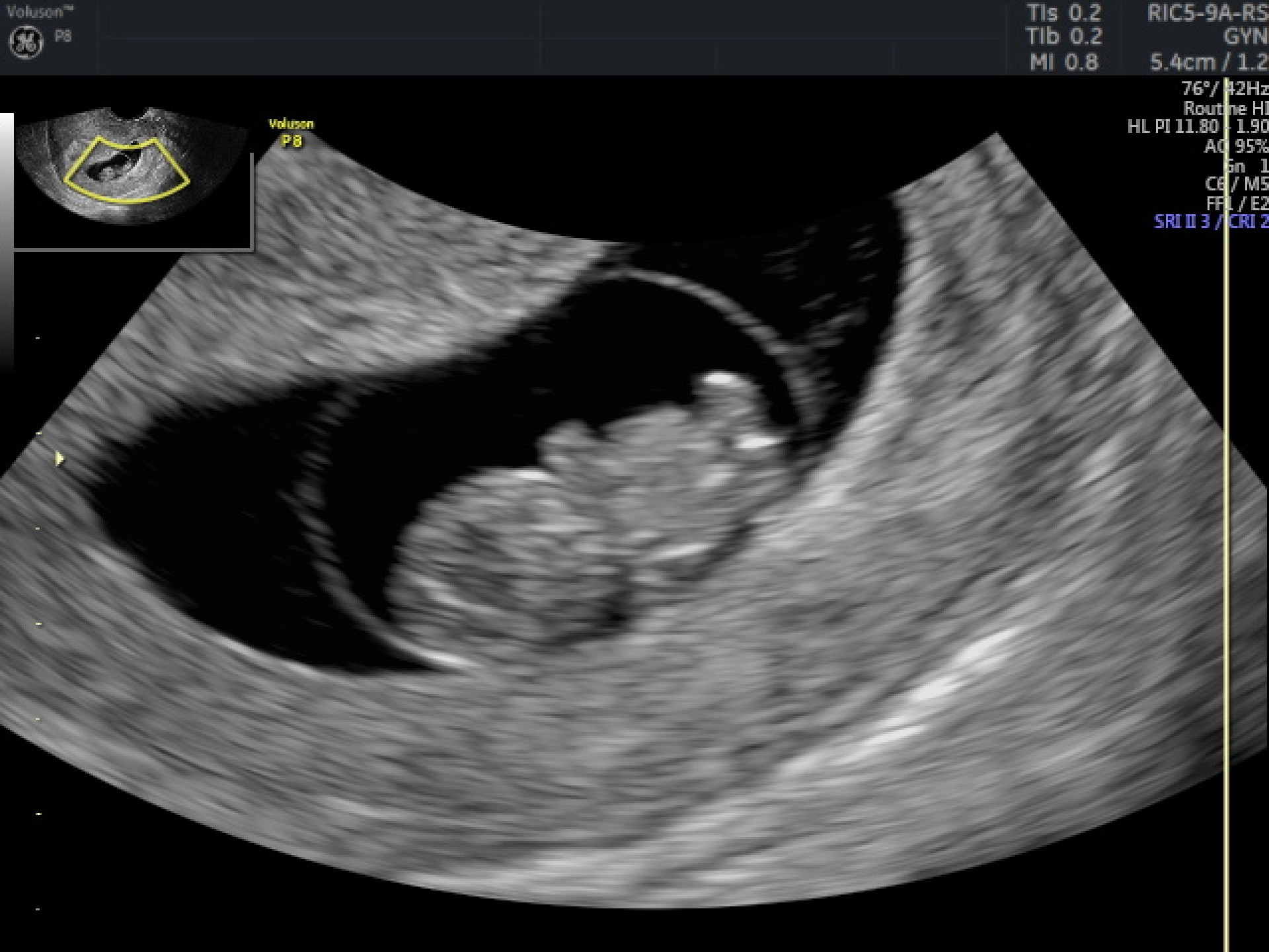 presentation pregnancy scan