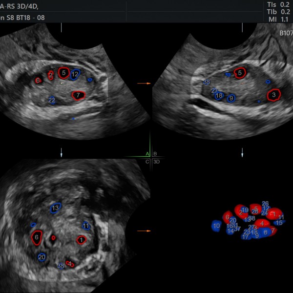 Fertility Scan Private OneOnOne Pregnancy & Fertility Ultrasound