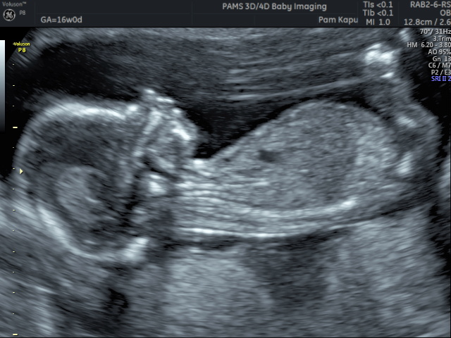 Gender Reveal Scan Private One On One Pregnancy And Fertility